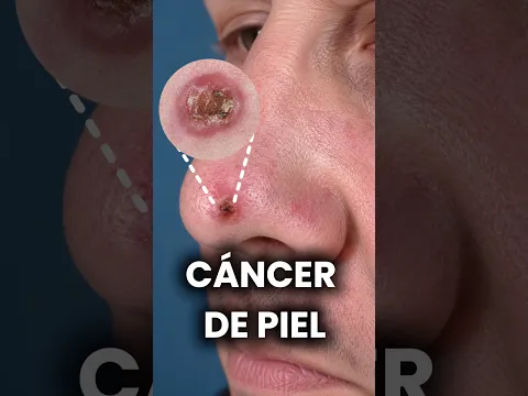 ¡Alerta! Este es el cáncer de piel más común. #dermatologia #dermatologo #medicina