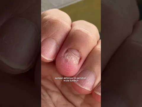 POV : pertumbuhan kuku copot setelah 5 minggu