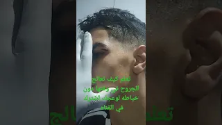 علاج الجروح بدون اثر للجروح من غير خياطه  علاج الجروح بدون اثر للجروح من غير خياطه