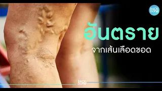 อาการเบื้องต้นของเส้นเลือดขอดมีอะไรบ้าง