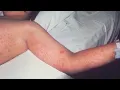 DO NOT WAIT JoCo says providers should report probable measles cases