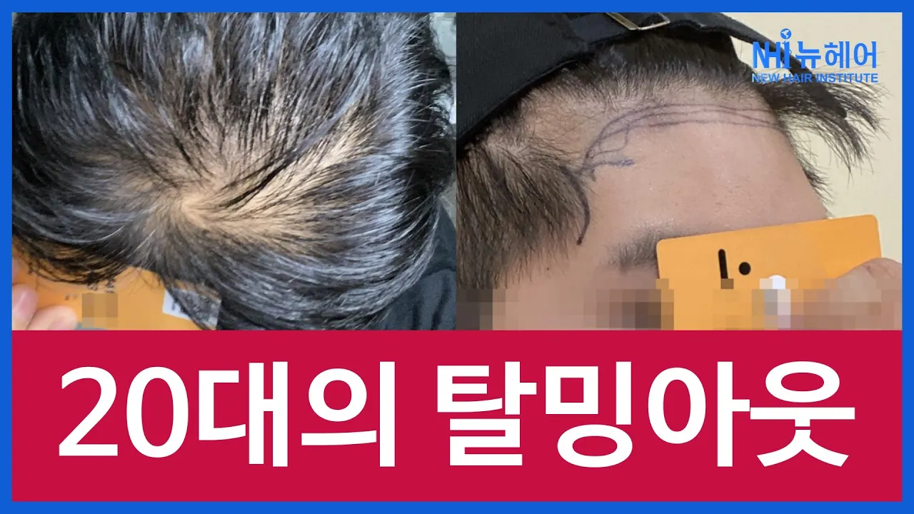 20대의 탈밍아웃! 모발이식? 미녹시딜? l 우리끼리 탈밍아웃 l 뉴헤어