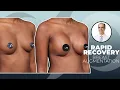 Beautiful Natural-Looking Breast Augmentation Result Dr Stoker