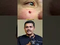 This type of birthmark is called as Hemangioma.