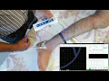 HOW TO USE SNCV Test Of Sural Nerve DEMO