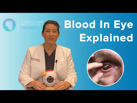 Subconjunctival Hemorrhage (Blood In Eye) Explained: Causes & Treatments