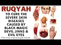 Download Lagu Ultimate Ruqyah to cure severe Skin Diseases,Infections\u0026Allergies due to Black Magic,Jinn\u0026Evil Eyes