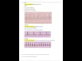 Relias Dysrhythmia Basic B Test 35 Questions and Answers 2023