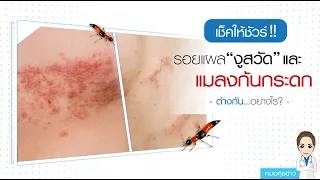  อาการจากแมลงก้นกระดกคล้ายกับโรคอะไรบ้าง 