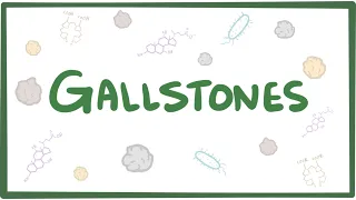 gallstones cholelithiasis 