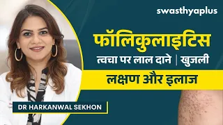 फॉलिकुलाइटिस: लक्षण और इलाज | Folliculitis in Hindi | Symptoms & Treatment | Dr Harkanwal Sekhon