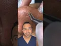 Download Lagu OMG I was not expecting that blackhead extraction on the nose! Dr Somji reacts