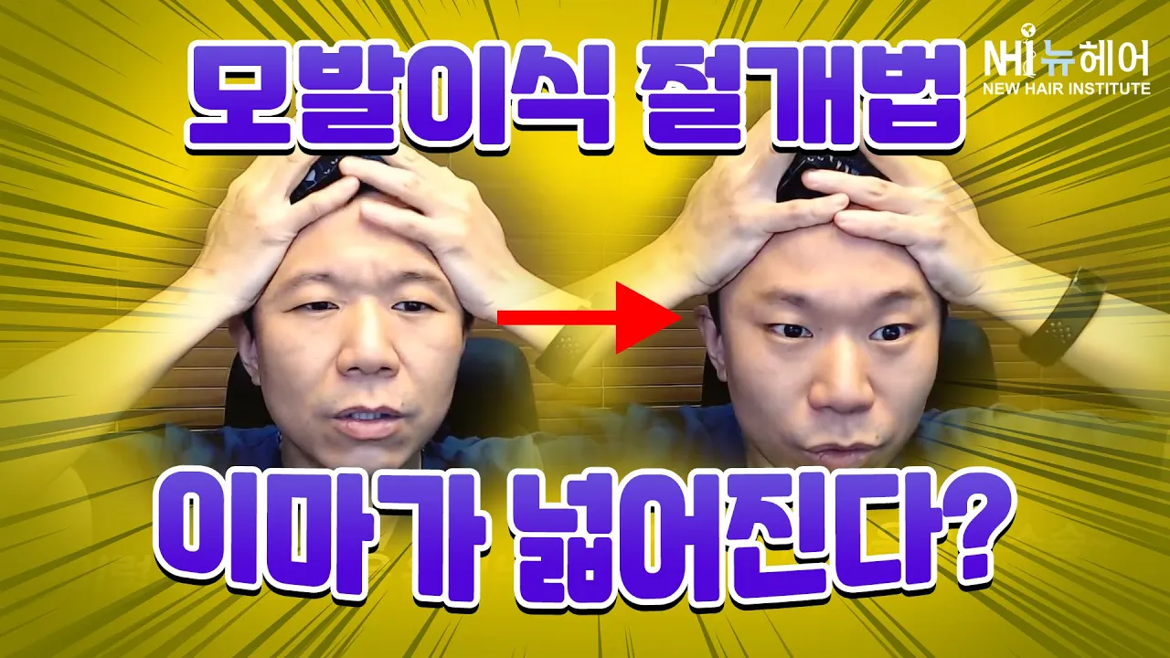 모발이식 절개 수술! 이마가 넓어진다? - 뉴헤어 I [모발이식]