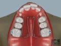 Quad Helix Appliance Part 2