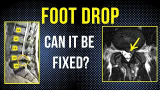 Foot Drop healed without surgery L4 - L5 Disc herniation