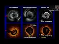 Samin K Sharma MD Interventional Cardiology Board Review 2024