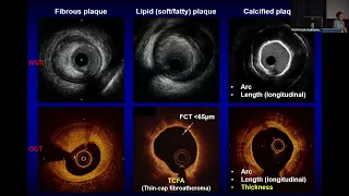 Samin K Sharma MD Interventional Cardiology Board Review 2024