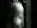 Twitching of top and outer right foot cramp fasciculation syndrome