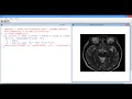 6 4 6 R6 Segmenting Images - 4 MRI Image