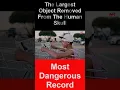 Download Lagu The Largest Object Removed From The Human Skull