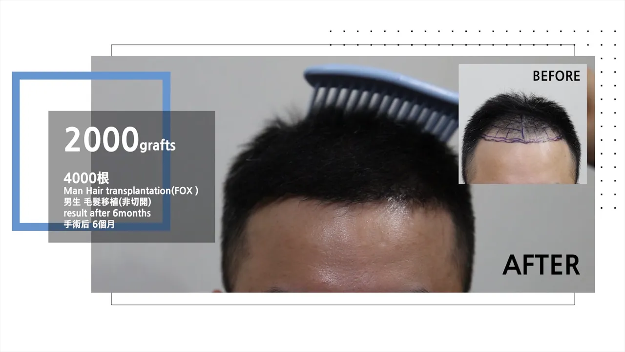 Man hair transplantation results after 12months - 뉴헤어 I 모발이식 I Before&After I