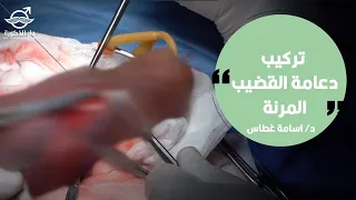 تركيب دعامة القضيب المرنة الدكتور اسامة غطاس 4971 