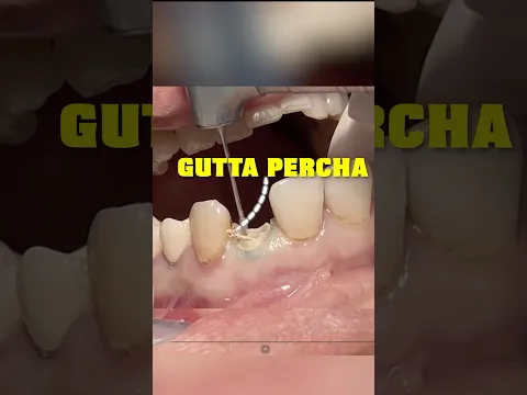What Happens When A Root Canal FAILS! 😳🦷