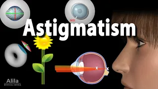 Astigmatism Types Causes Symptoms and Treatment Options Animation