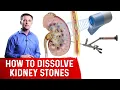 How To Dissolve Kidney Stones Explained By Dr Berg