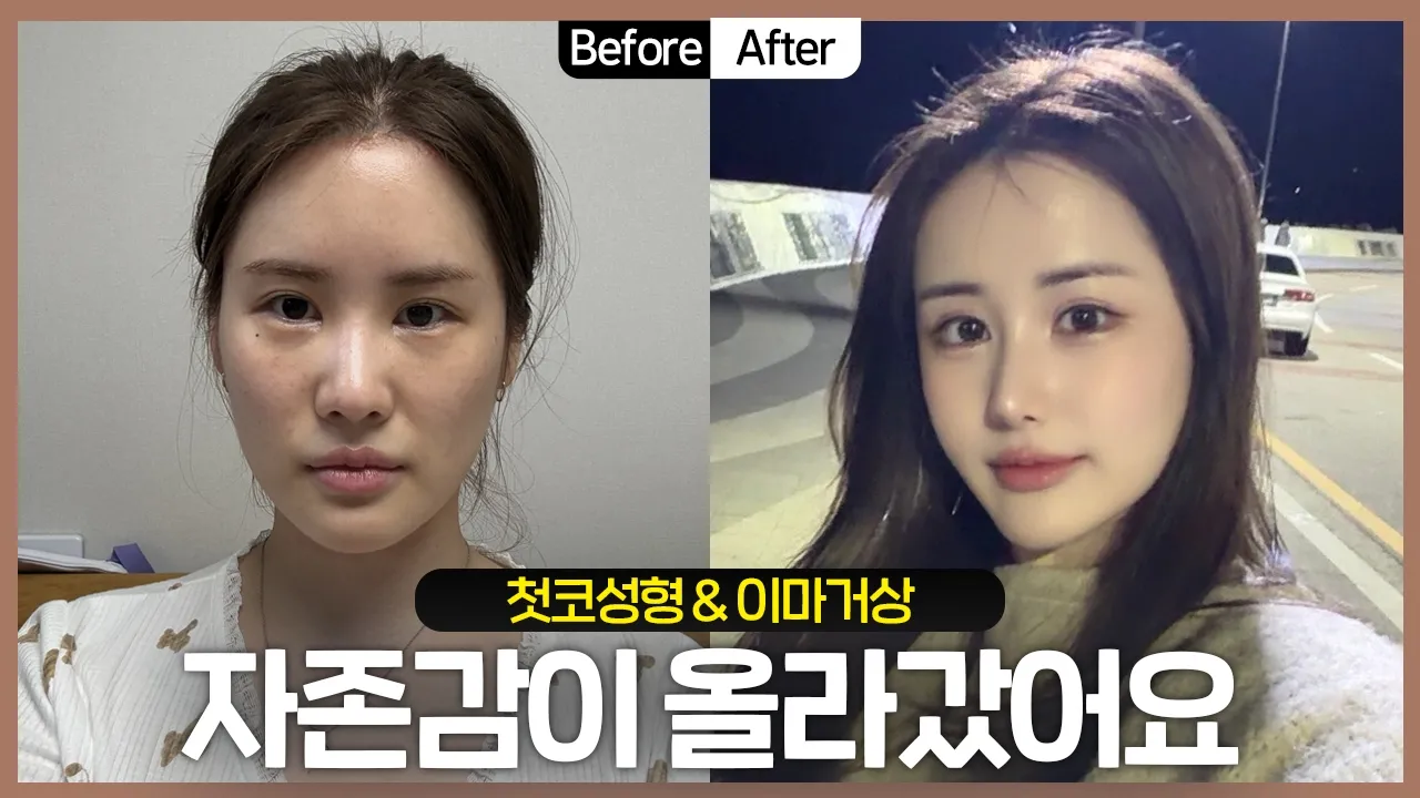 [리얼후기] 지금은 자존감이 많이 올라갔어요😎 #성형전후 #코성형후기 #이마거상후기