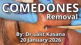 Comedones Removal By Dr.Lalit Kasana / New Blackheads removal video