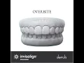 Overbite INVISALIGN