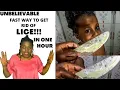 How to Get Rid of Head Lice in 1 Hour Very Simple Technique