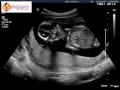 Front view 16 week ultrasound