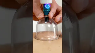 What is cupping