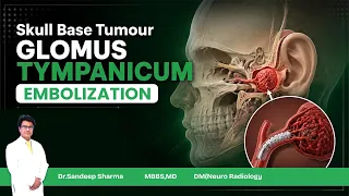 skull base tumour Glomus Tympanicum Embolization.