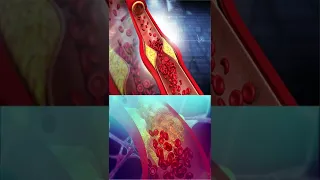 ए ज य प ल स ट स ट ट लग न क ब द ज वन न र मल रहत ह CAN YOU LIVE A NORMAL LIFE WITH HEART STENT 