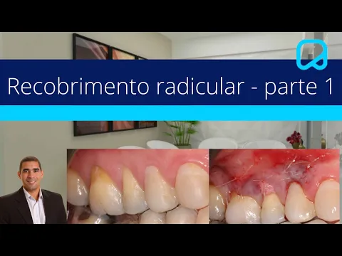 Download MP3 Recobrimento radicular -  parte 1 @dr.alexguedes