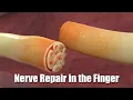Download Lagu Nerve Repair in the Finger
