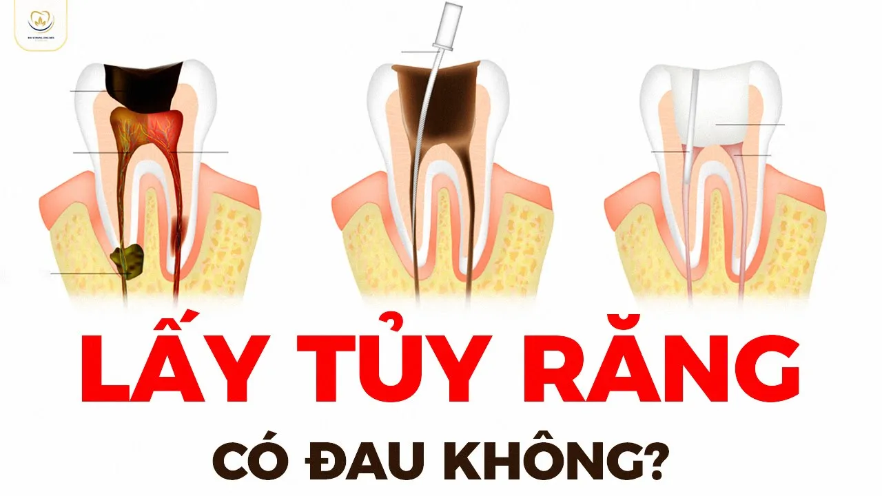 Outline Video Lấy Tủy Răng Có Thực Sự Đau Không | Bác sĩ Trung Long Biên