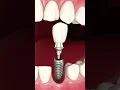 Dental Implants the gold standard solution for missing teeth