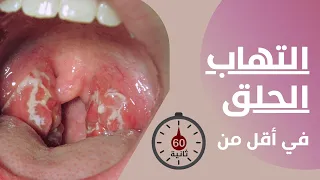 التهاب الحلق في أقل من    ثانية دندنها