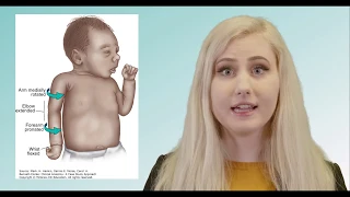 Erb s Palsy