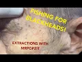 This one has it all Blackheads whiteheads and a bonus Steatocystoma See how I change it up