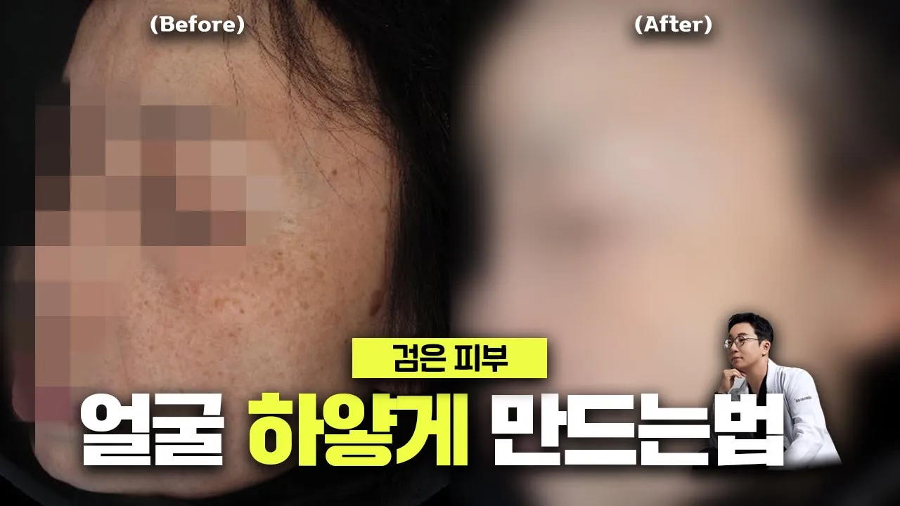 피부과 의사가 알려주는 피부 미백의 비결은 XXX입니다 / 검은피부 하얗게 만드는 방법