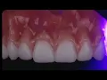 TOP TIP Join me as I explain how I characterize my 3D printed dentures