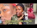 HOW TO PROPERLY USE THE ORDINARY PEELING SOLUTION FOR BEGINNERS Step by Step Guide