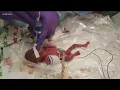 World s smallest surviving baby born in San Diego