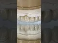 Download Lagu Monet Pure Zirconia Anteriors #lsk121shorts #dentist #teeth