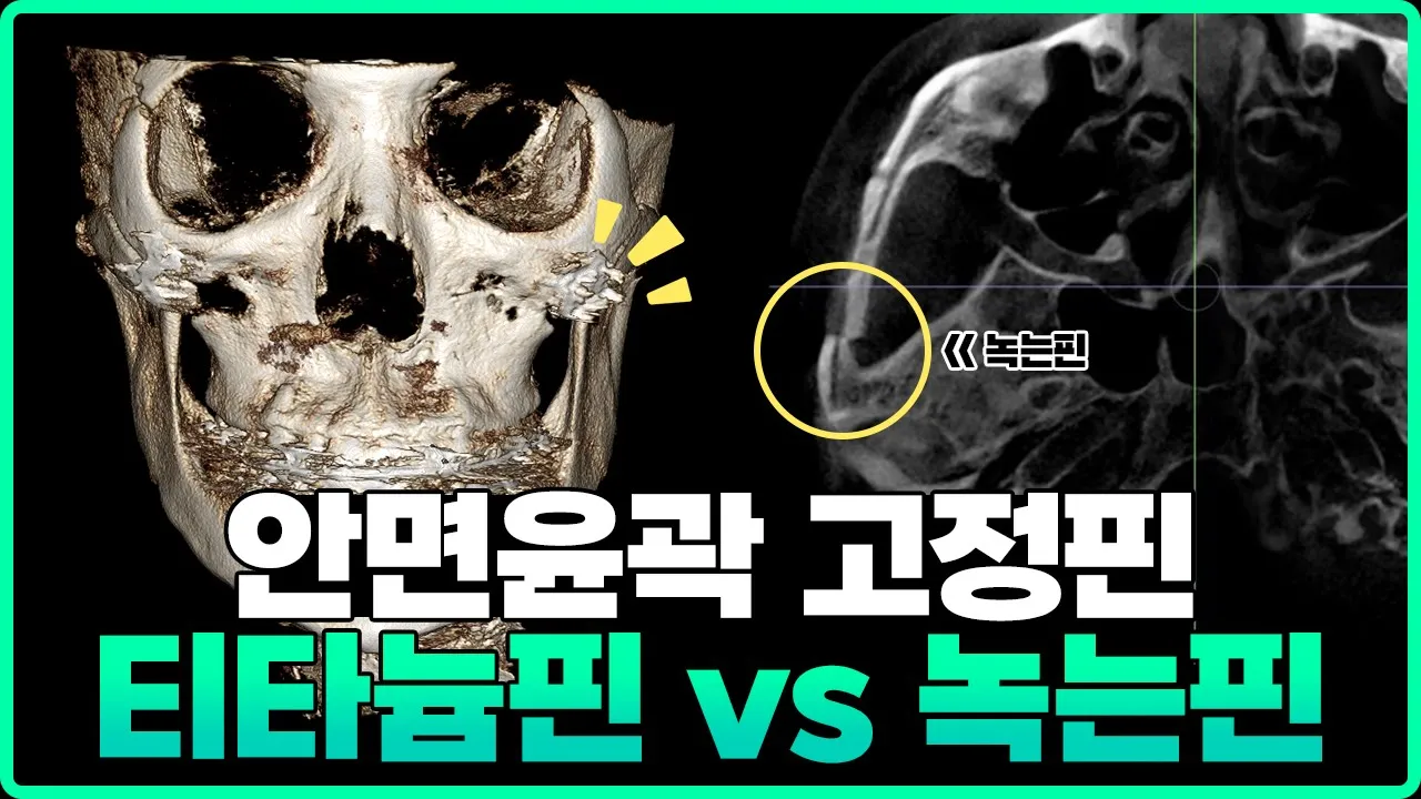 핀제거수술 꼭 해야 돼? 안면윤곽 녹는핀 부작용은 없을까?